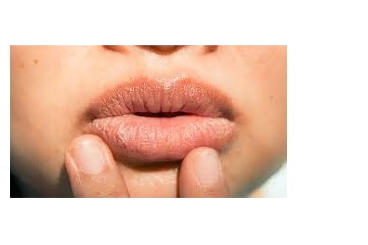Labbra scottate dal sole: prevenzione e cure Labbra scottate dal sole: prevenzione e cure