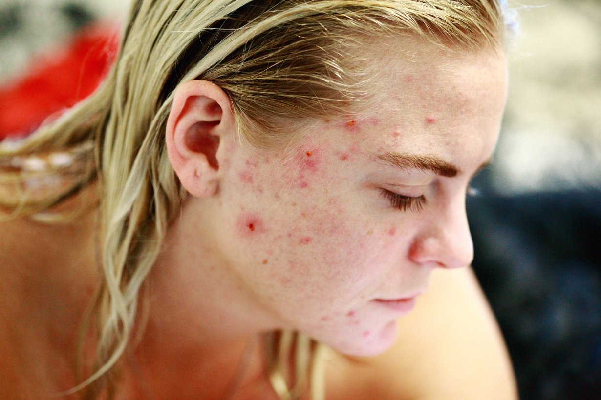 Acne e sole: consigli contro le macchie e le cicatrici Acne e sole: consigli contro le macchie e le cicatrici