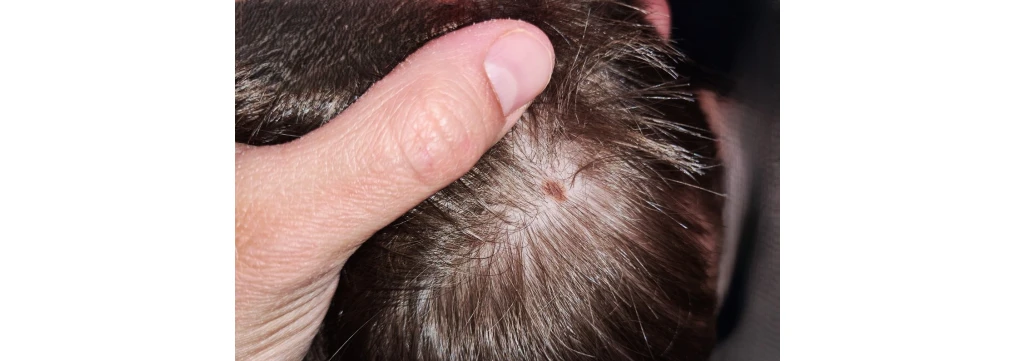 Nei in testa e melanoma del cuoio capelluto: quando preoccuparsi davvero Nei in testa e melanoma del cuoio capelluto: quando preoccuparsi davvero