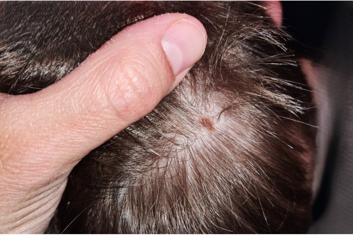 Nei in testa e melanoma del cuoio capelluto: quando preoccuparsi davvero