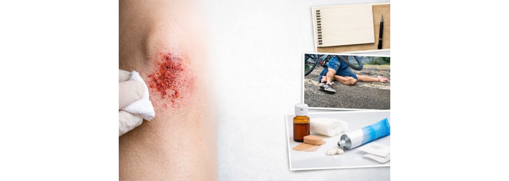 Abrasione: cos’è, differenza con escoriazione, cosa mettere e come farla guarire velocemente Abrasione: cos’è, differenza con escoriazione, cosa mettere e come farla guarire velocemente