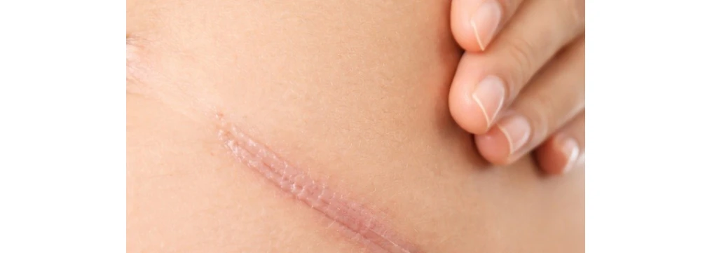 A cosa serve Kelo-Cote e qual è il miglior gel al silicone per le cicatrici