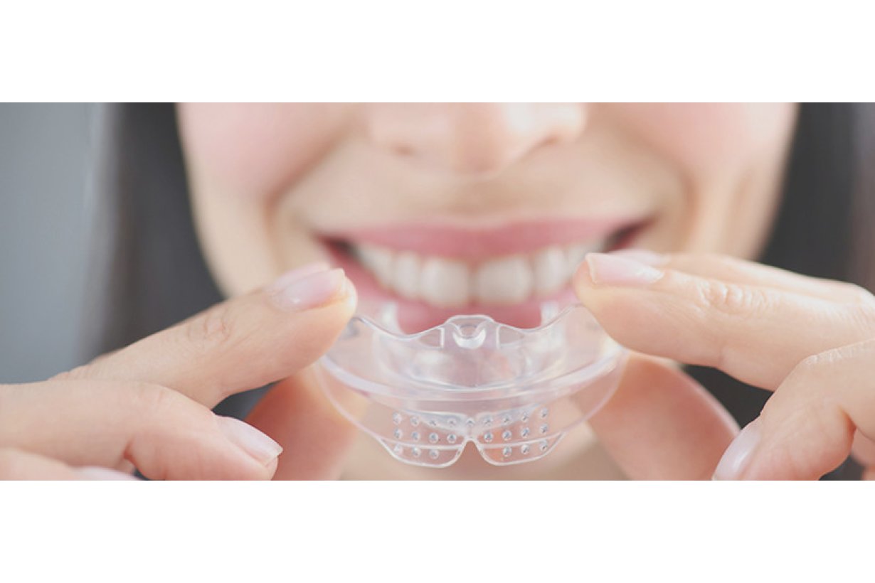 Bite notturno: costo, benefici, durata e controindicazioni. Guida completa