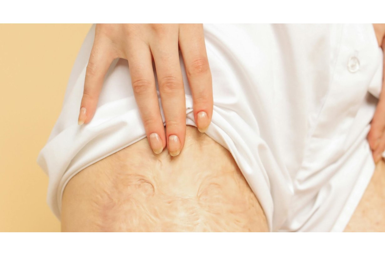 Cellulite e Palestra: Come Eliminare la Cellulite con l'Esercizio Fisico Cellulite e Palestra: Come Eliminare la Cellulite con l'Esercizio Fisico