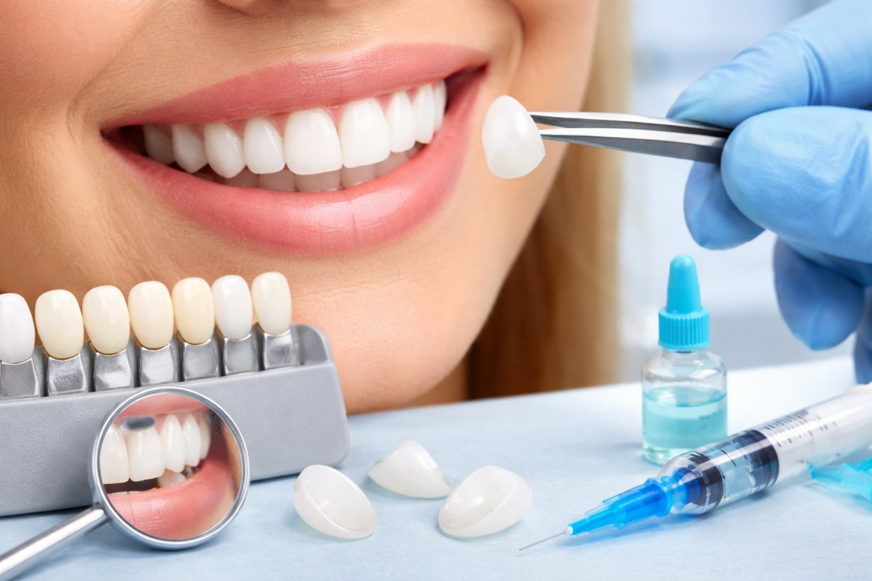 Faccette dentali: costi, durata, svantaggi e cosa mangiare Faccette dentali: costi, durata, svantaggi e cosa mangiare