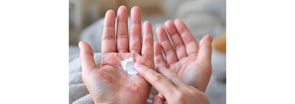 Eczema alle mani: cause, stress e come prendersi cura della pelle Eczema alle mani: cause, stress e come prendersi cura della pelle