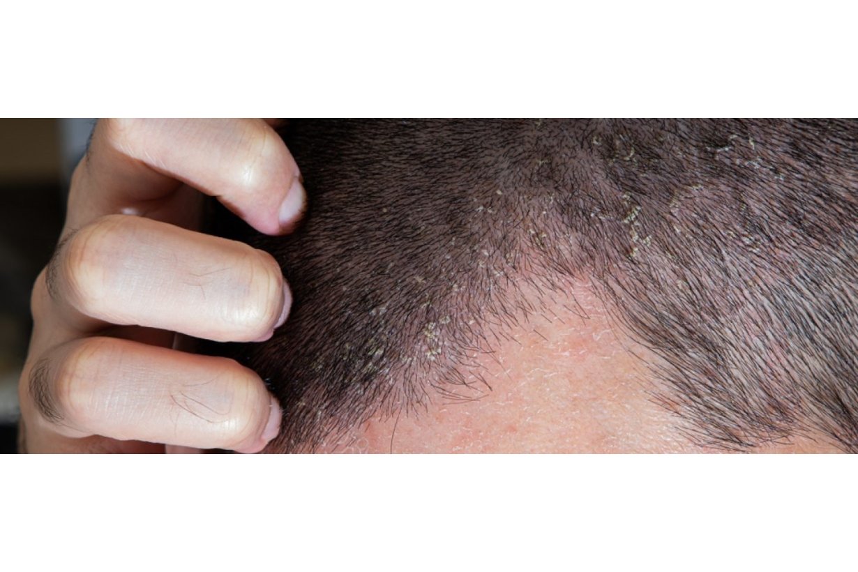 Dermatite seborroica: Cos'è, cause e cure Dermatite seborroica: Cos'è, cause e cure