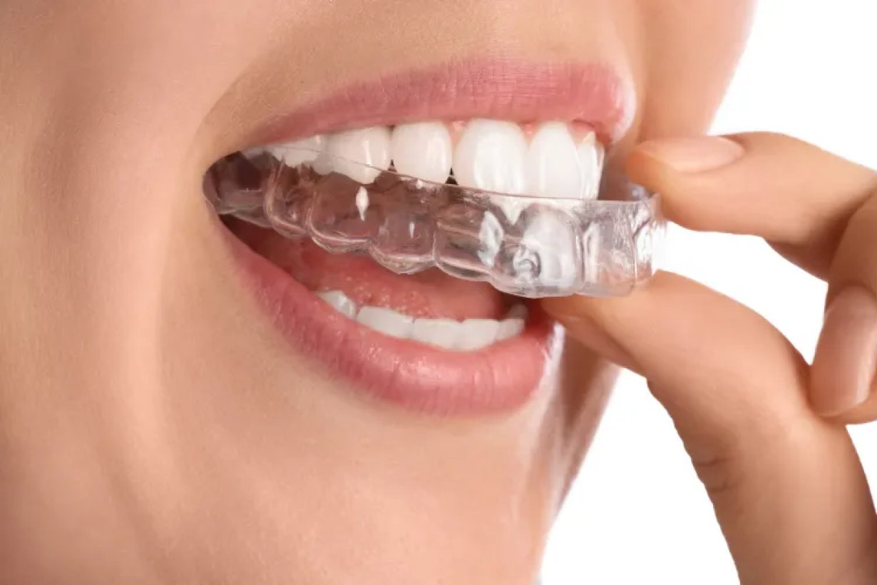 Contenzione dopo apparecchio: cosa fare senza denti del giudizio