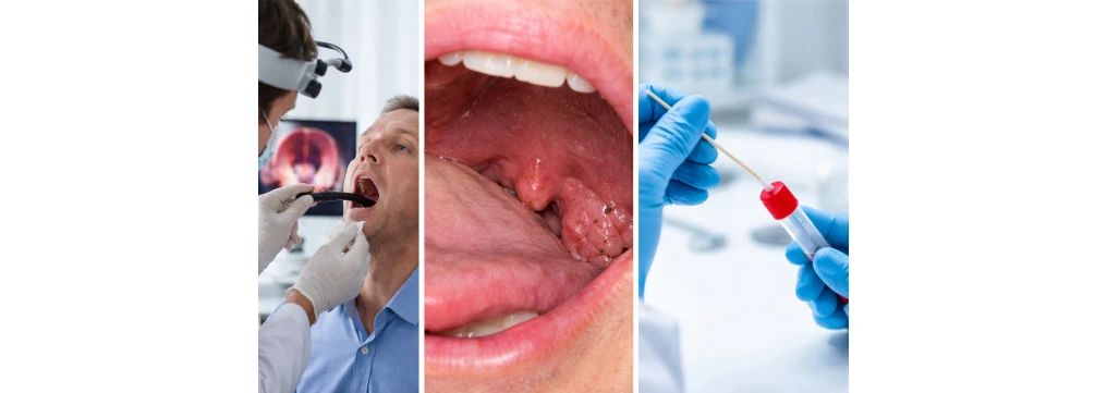 HPV in gola: sintomi, trasmissione e cura del papilloma laringeo