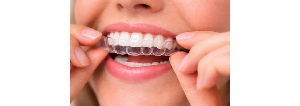 Quanto dura la contenzione dopo l'apparecchio: tempi, retainer e consigli utili