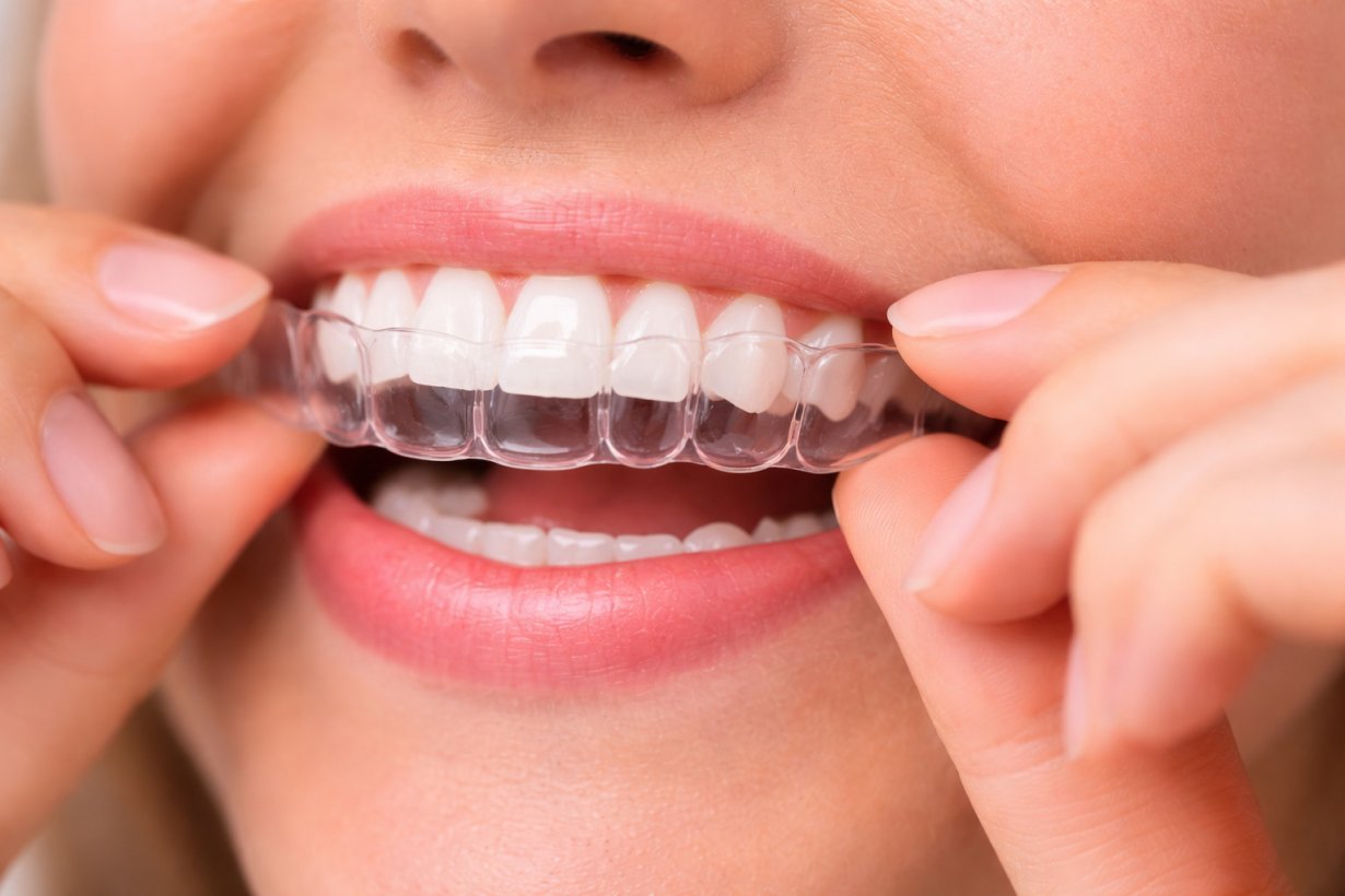 Quanto dura la contenzione dopo l'apparecchio: tempi, retainer e consigli utili