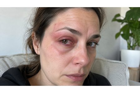 Herpes oculare e zoster oftalmico: come riconoscerli, come si curano e quanto durano