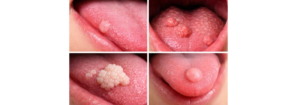 Escrescenze sulla Lingua: Cause, Sintomi e Quando Preoccuparsi Escrescenze sulla Lingua: Cause, Sintomi e Quando Preoccuparsi