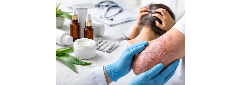 Psoriasi: cos’è, perché viene, come riconoscerla e come si cura