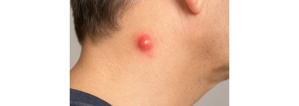 Cisti sebacea infiammata: come sfiammarla, pomate utili, pericoli e drenaggio