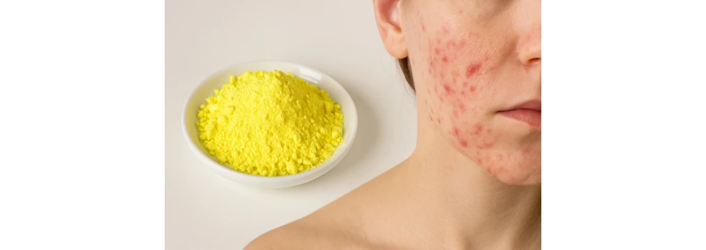 Lo zolfo contro i brufoli: funziona davvero? Guida completa e naturale all'acne
