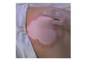 ALLEVYN SACRUM 22,5X22,1 10PZ